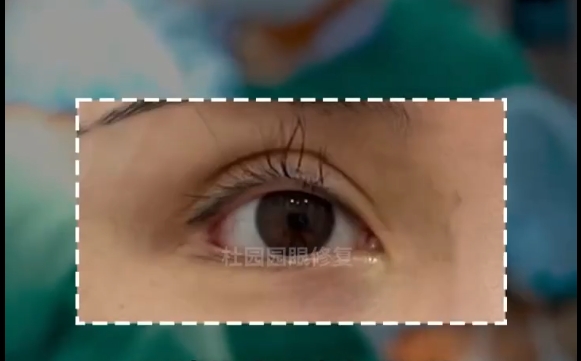 雙眼皮術(shù)后效果，看近期還是遠(yuǎn)期？杜園園醫(yī)生告訴你