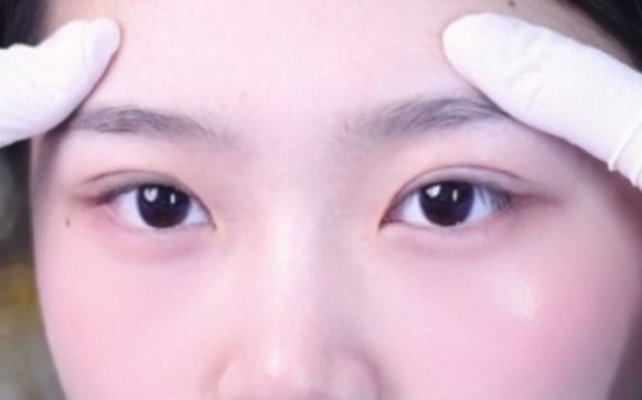 雙眼皮手術(shù)：如何打造開扇雙眼皮？周顯玉醫(yī)生案例分享