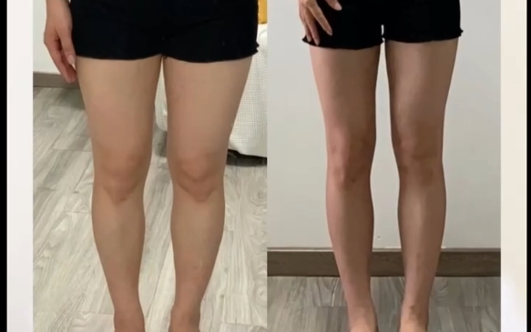 吸脂從胖到瘦的幾個階段，程辰醫(yī)生在線解析