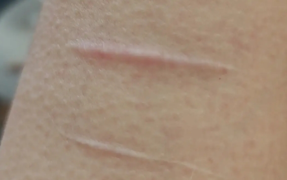 如何祛疤？5種常見(jiàn)疤痕，教你掌握不同疤痕的應(yīng)對(duì)方法