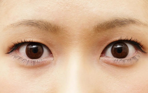 上瞼下垂是否能一次到位？周顯玉醫(yī)生解答