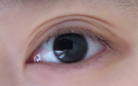 雙眼皮術后出現(xiàn)多層雙眼皮是什么情況？