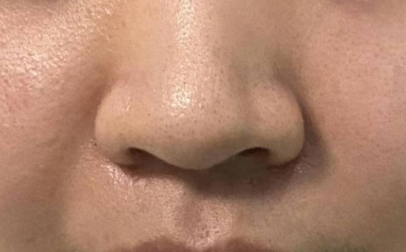 千萬不要外切你的鼻翼，讓你的鼻頭自然縮小