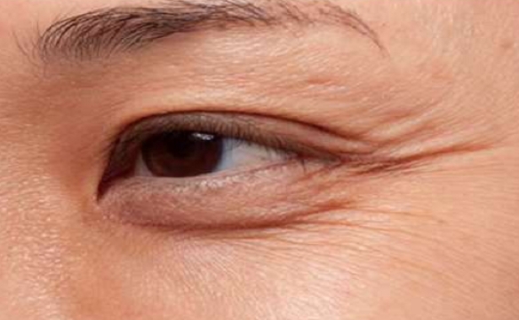 做小拉皮手術能改善魚尾紋嗎？范飛醫(yī)生告訴你