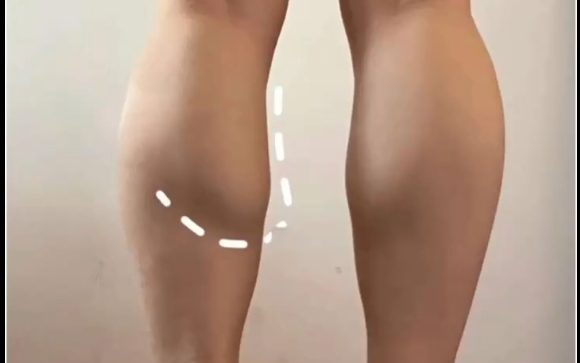 女生腿粗很難瘦？你真的了解自己的腿嗎？