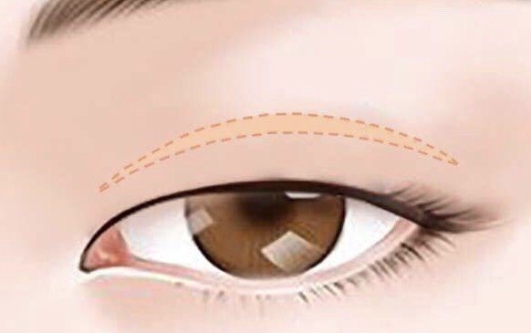 上海九院專家教你1分鐘自測(cè)雙瞼下垂