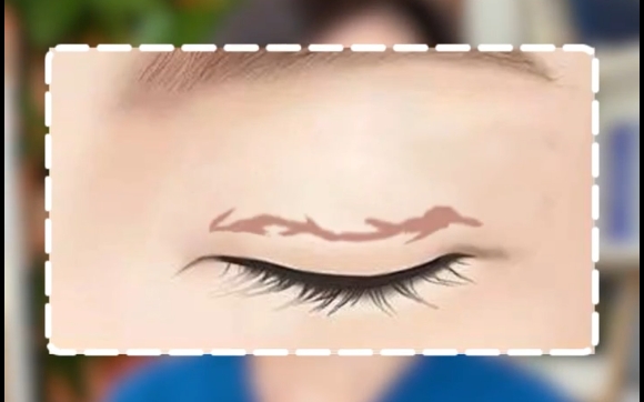 雙眼皮疤痕嚴重，唯二可以去皮的情況。杜園園醫(yī)生告訴你