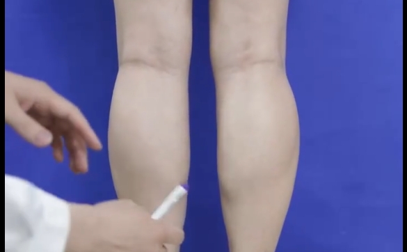 瘦腿針？吸脂？到底哪個方式可以改善小腿粗？