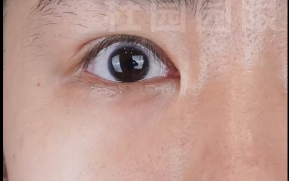 重度上瞼退縮，單眼修復(fù)實例。杜園園醫(yī)生案例分享