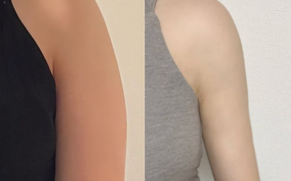 吸脂后多久能瘦？穿塑身衣和吸脂恢復(fù)的關(guān)系