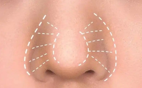 縮鼻翼再好，這3種人統(tǒng)統(tǒng)勸退！