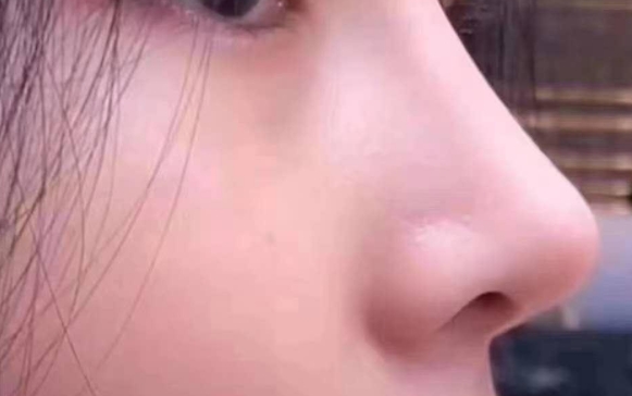 鼻背長痘一直沒有消，醫(yī)生：別扣了，線穿出來了！
