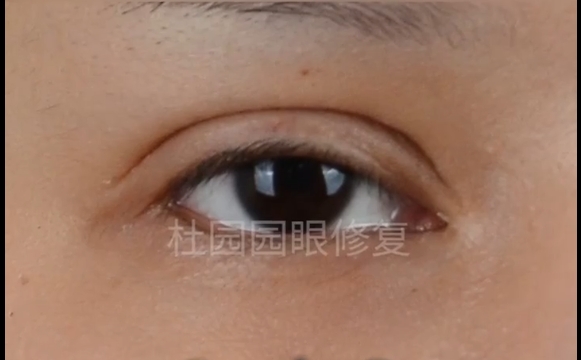 中重度上瞼下垂修復(fù)后，還會復(fù)發(fā)？杜園園醫(yī)生為你解答