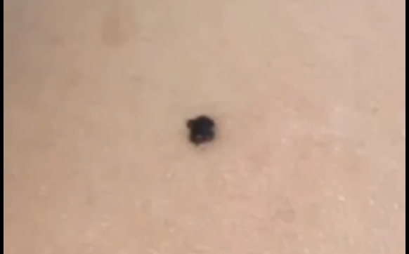 馮少清醫(yī)生教你五個字母，分辨痣的好壞！