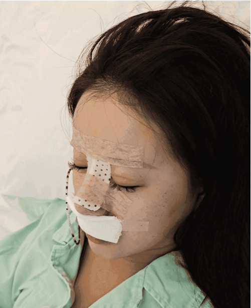 * 主題 重慶星宸醫(yī)院隆鼻怎么樣？真實(shí)隆鼻案例分享及價(jià)格表