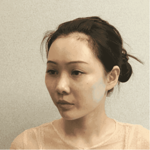 北京八大處磨骨多少錢(qián)？2022價(jià)格表曝光+磨骨案例