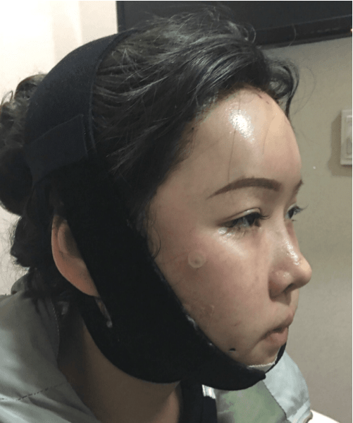 北京八大處磨骨多少錢(qián)？2022價(jià)格表曝光+磨骨案例