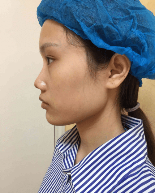 四川省成都軍建醫(yī)院怎么樣？價(jià)格表曝光+隆鼻真人案例分享