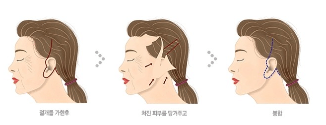 大拉皮和小拉皮手術(shù)的區(qū)別在哪里？效果維持時間多久？