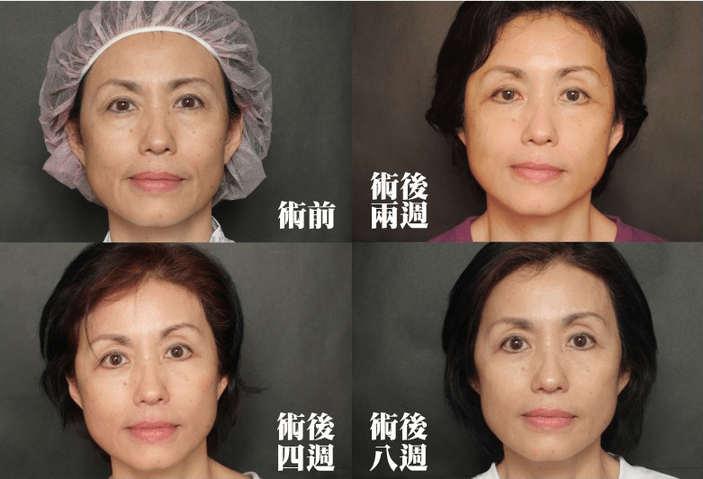 大拉皮和小拉皮手術(shù)的區(qū)別在哪里？效果維持時間多久？