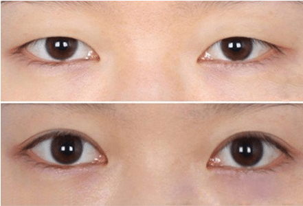 開眼角整形手術(shù)有什么好處