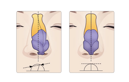 歪鼻矯正是怎么做的?適應(yīng)癥有哪些?