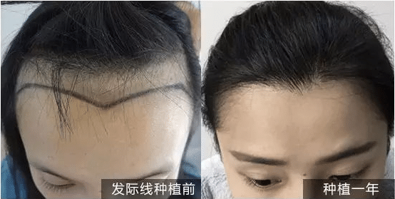 發(fā)際線后移怎么辦?可以植發(fā)際線嗎?