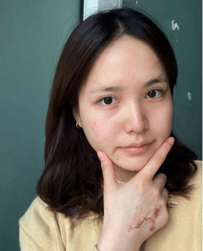 成都軍建醫(yī)院疤痕科怎么樣？附祛疤真人案例一覽