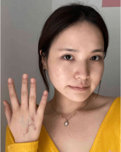 成都軍建醫(yī)院疤痕科怎么樣？附祛疤真人案例一覽