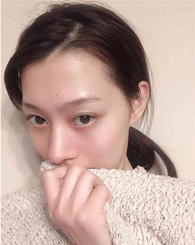 杭州連天美醫(yī)療美容醫(yī)院怎么樣？隆鼻前后效果一覽