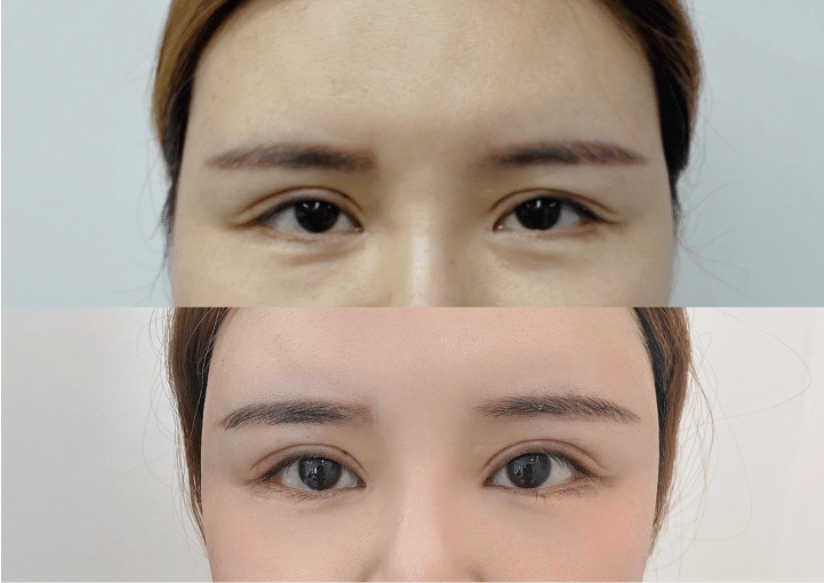 雙眼皮修復(fù)前后對(duì)比