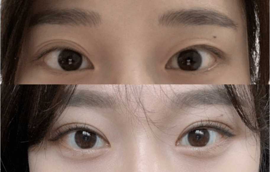 雙眼皮修復(fù)前后對(duì)比