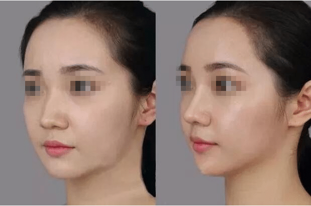 隆鼻術后對比