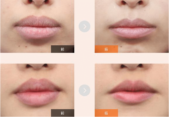 怎么讓嘴皮變薄?厚唇改薄術(shù)恢復(fù)時間要多久?