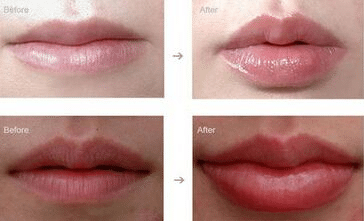 豐唇前后對(duì)比