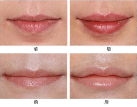 豐唇前后對(duì)比