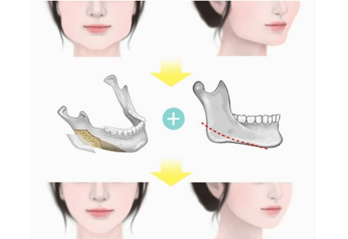 下頜角整形