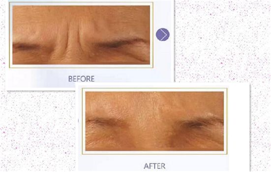 怎么去除川字紋