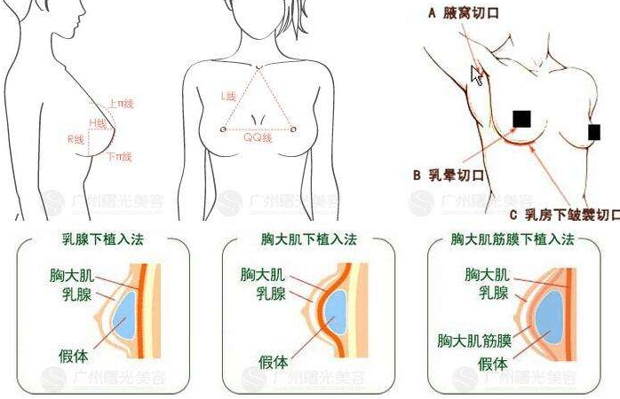 隆胸整形價(jià)格