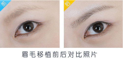 眉毛的價格一般是多少?種植眉毛可以維持多長時間