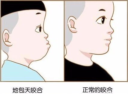 地包天能不能矯正過(guò)來(lái)呢?地包天是如何形成的?