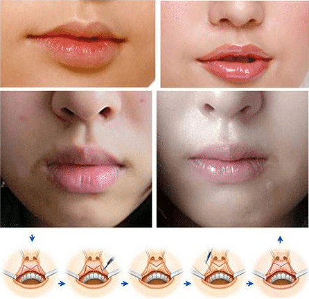 嘴唇厚嘴唇不好怎么辦?厚唇改薄會增生嗎?