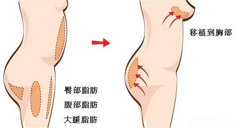 自體脂肪隆胸效果怎么樣？存活率高不高