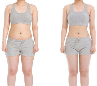 水動力吸脂前后對比 水動力吸脂前后對比