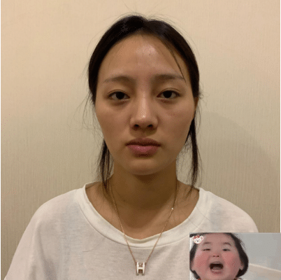 北京新星靚做面部脂肪填充效果好不好？