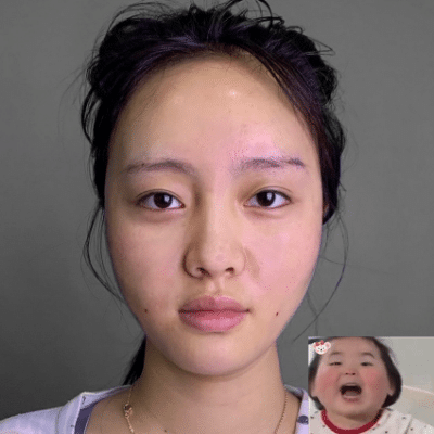 北京新星靚做面部脂肪填充效果好不好？