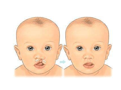 兔唇必須要修復(fù)嗎?怎么修復(fù)兔唇?