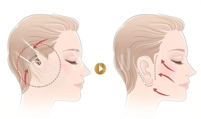 廣州拉皮除皺手術(shù)多少錢(qián)?皮膚提拉除皺果如何?