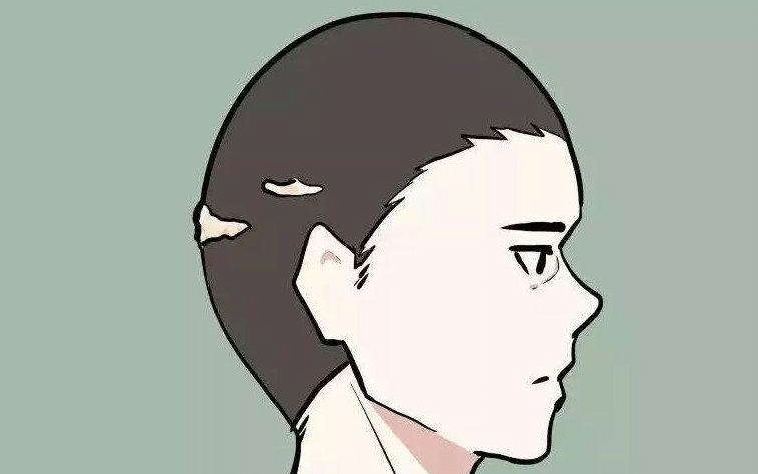 什么是疤痕植發(fā)？術(shù)后需要注意什么？