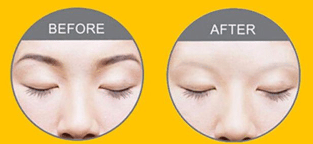 激光洗眉前后對(duì)比